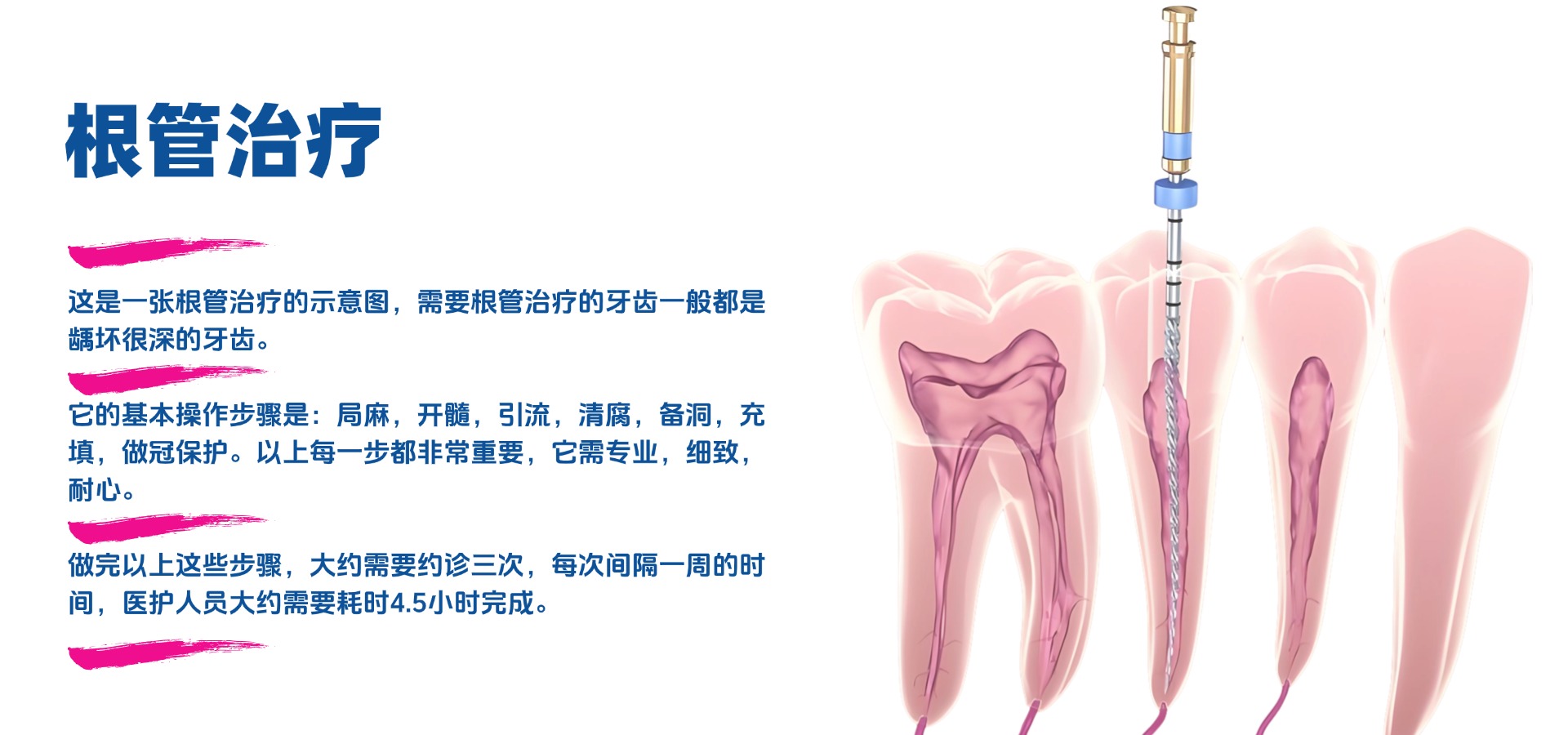 根管治疗