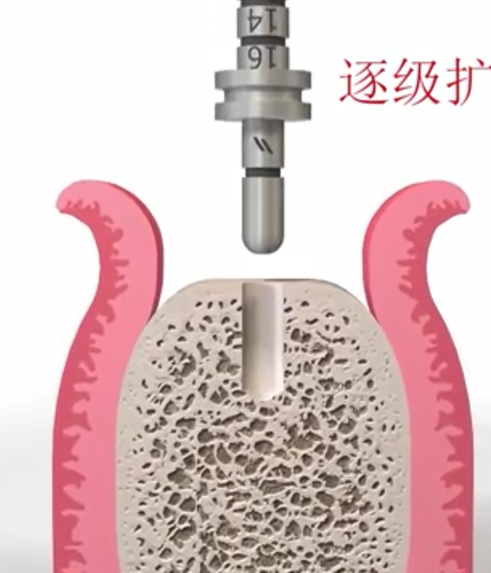 种植牙全过程动画演示详细步骤全解析