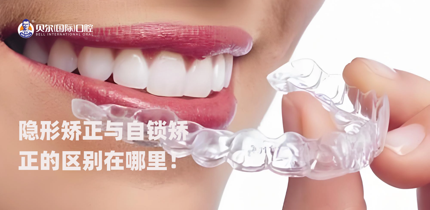 隐形矫正与自锁矫正的区别在哪里?